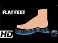 FLAT FEET Everything You Need To Know