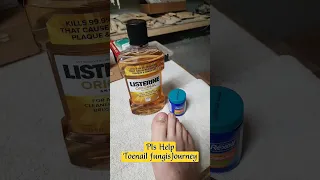 How To Treat Foot Fungus At Home Updated 3 17 24 Diy Fungus Toenailfungus Feet Toenails Toes 