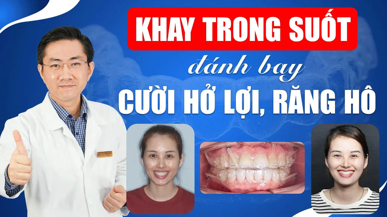 Outline Video Niềng Răng Khay Trong Suốt Đánh Bay Cười Hở Lợi, Răng Hô | Nam Bùi Vinalign