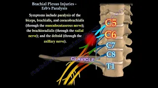 Brachial Plexus Injuries Erb s Klumpke s Palsy