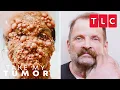 WILDEST Tumor Removals Take My Tumor TLC