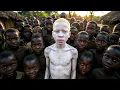 Being Albino in Africa The Horrifying Reality