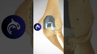 Total Elbow Replacement TER