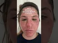 C02 Laser Resurfacing Before During After