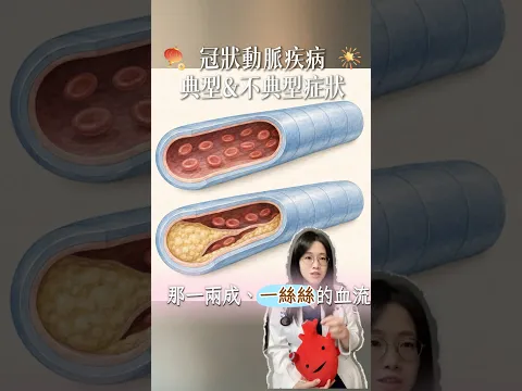 冠心症 02典型【動的時候悶，休息一下就好】