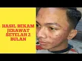 Download Lagu Acne cupping results after 2 months HASIL BEKAM JERAWAT SETELAH 2 BULAN.