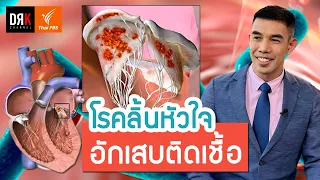  สาเหตุหลักที่ทำให้เกิดโรคลิ้นหัวใจอักเสบติดเชื้อคืออะไร 