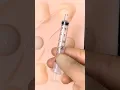 Proper Abscess Drainage Loop Technique