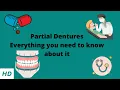 PARTIAL DENTURE Everything you need to know about them