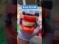 Download Lagu Braces colors you should be getting!🤩✨ #jeffersondental #braces #bracescolors #bestbraces