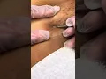Ingrown hair blackhead removal after a bikini wax