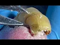 Download Lagu Extra Long Yellow Onychomycosis! Its Full Of Germs And Dirt Down There【Pedicure Master Lin Jun】