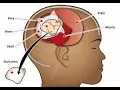 Craniotomy with elevation of bone flap CPT code - simplify medical coding