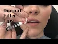 Dermal Filler Lips 1 Syringe RESTYLANE