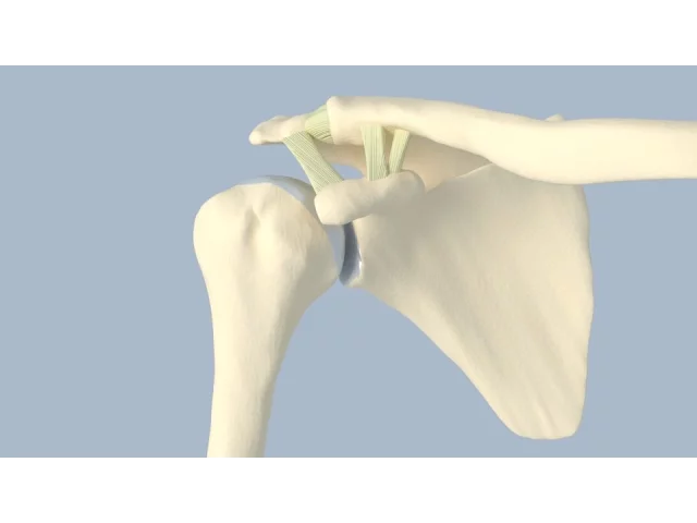 Acromioclavicular Separation Surgery