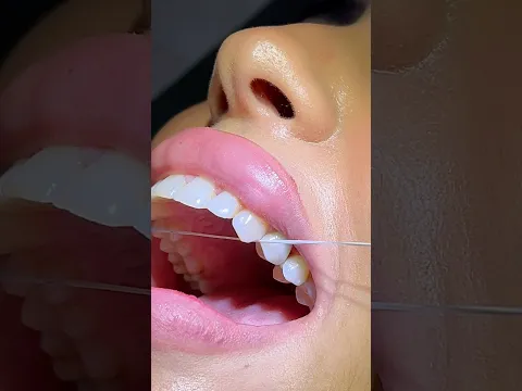 تركيب السن المفقود بعد فترة الإلتئام ✨ #dentistry #dentist #implants #زراعة_الاسنان  #اكسبلور