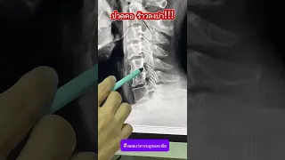  อาการปวดต้นคอและแขนร้าวลงมาเกิดจากสาเหตุอะไรบ้าง 