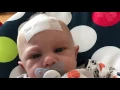 Download Lagu Metopic craniosynostosis