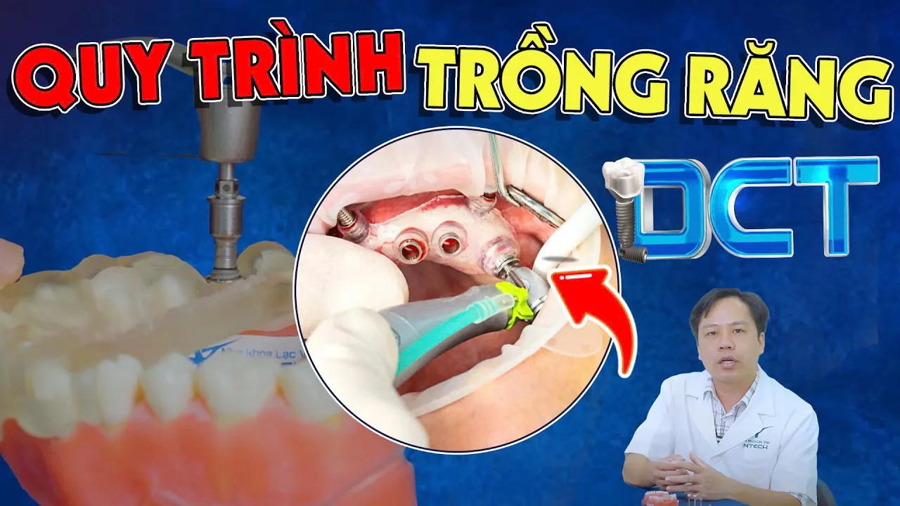 Outline Video Quy Trình Trồng Răng Implant DCT: 4 Bước Bắt Buộc Trong Quy Trình Trồng Răng Implant, Lưu Ý Bước 2