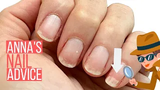 WHITE PATCHES ON NAILS ANNA HELP ANNA S NAIL ADVICE