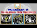 How to read CT scan abdomen - Colon appendix