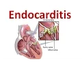 Download Lagu Endocarditis