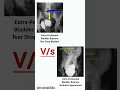 Extra intraperitoneal bladder rupture