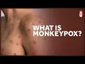 Monkeypox What is It and Who is at Risk