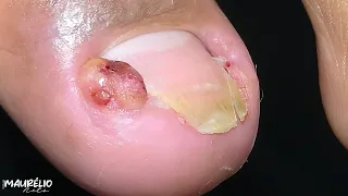 ELE TENTOU CORTAR A UNHA ENCRAVADA SOZINHO... E SÓ PIOROU #podologomaurelio #satisfying