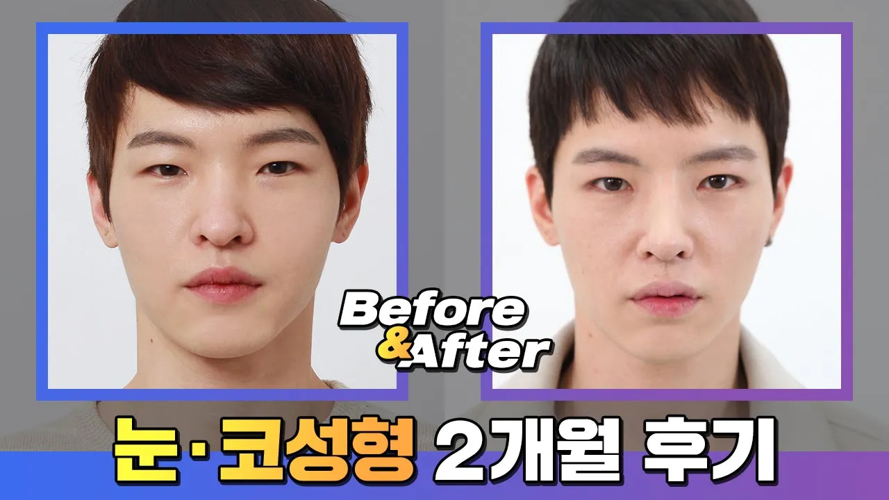 보정없는 남자 코성형후기_남자코성형 남자눈성형(속쌍꺼풀)2개월 비교후기