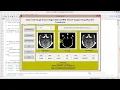 Image Fusion On MRI and CT Image Using Image Processing Matlab Project Code