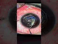 Download Lagu ReLEX Smile Eye Surgery - The First Minimally Invasive Flap Less Solution.  #eye #smileeyesurgery