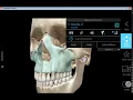 Anatomy of the Maxillae and Occipital Bone