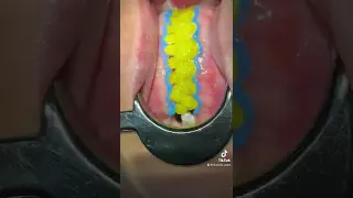 Teeth Whitning تبيض الأسنان 