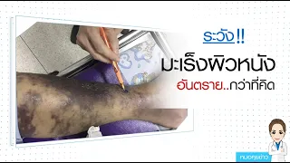 สาเหตุที่ทำให้เกิดมะเร็งเนื้อเยื่ออ่อนมีอะไรบ้าง