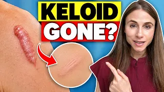 Can Keloid Scars Be Removed? Dermatologist Q&A