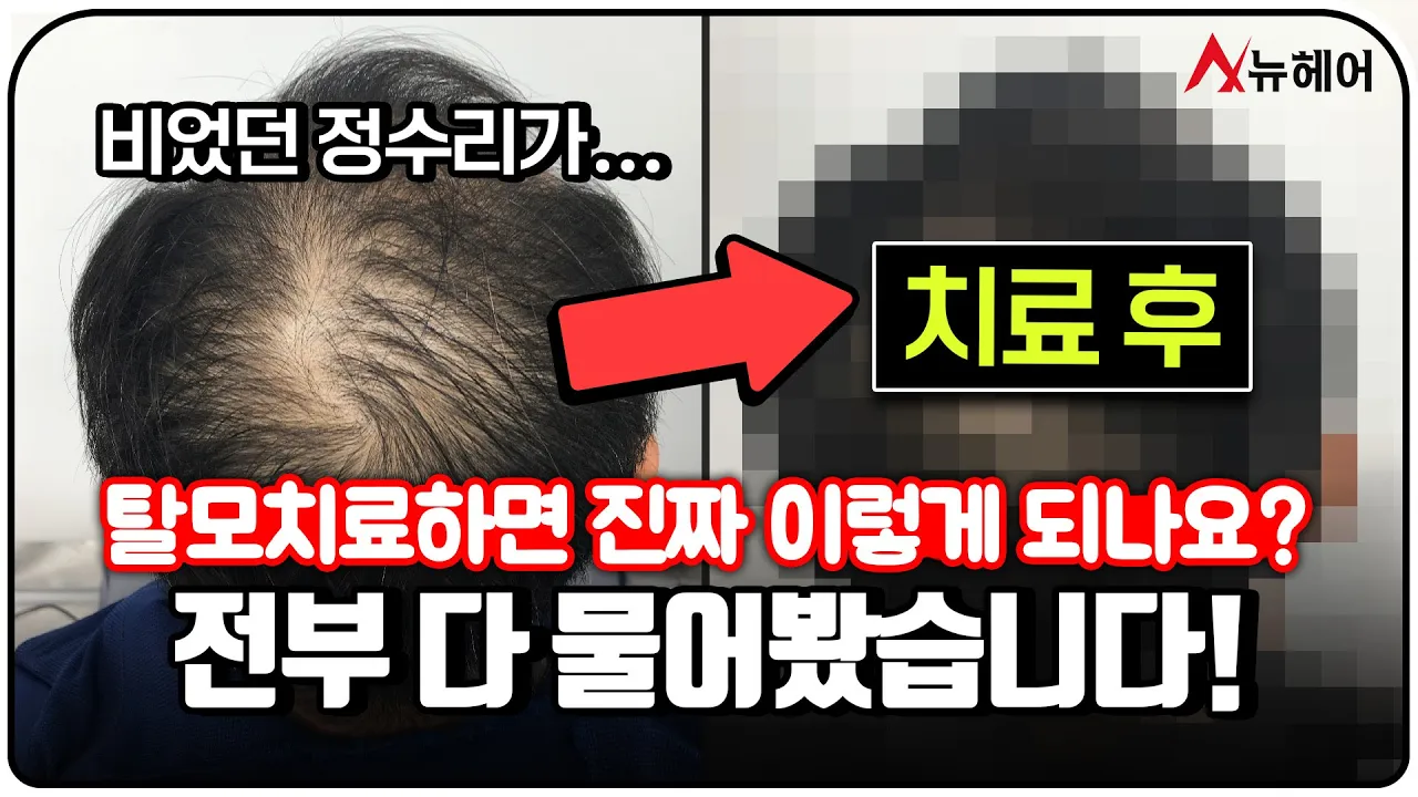 17년 차 탈모의사가 밝힌 탈모치료(주사) 효과, 부작용, 내성ㅣ뉴헤어