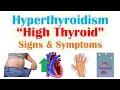 Hyperthyroidism Thyroid Storm Signs Symptoms Why They Occur