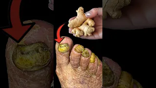 Cure Foot Fungus Instantly With Ginger 
