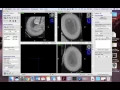 sample itk SNAP semi-automatic segmentation