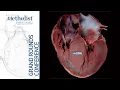 Is There a Doctor on Board Arrhythmias in Athletes M Narezkin MD A Lador MD June 11 2020