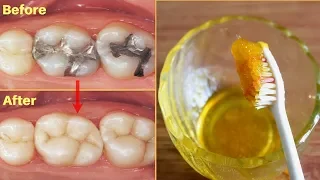 Download एक बार में दांत का कीड़ा और दर्द बाहर निकालने का बेहतरीन उपाय - How To Get Rid Of Tooth Cavity MP3
