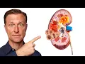 The TOP Best Foods to Improve Kidney Function END STAGE KIDNEY DISEASE