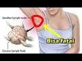 Download Lagu Bisa Fatal, 7 Penyebab Rasa Sakit di Ketiak yang Harus Kamu Waspadai