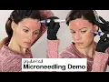 Microneedling at Home - TIPS WARNINGS DEMO