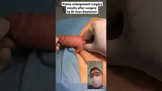 Penile Enlargement Surgery Results After Surgery By Dr Araz Bayramov Andrologist Penis 