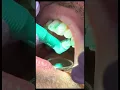 teeth cleaning at the dentist step by step