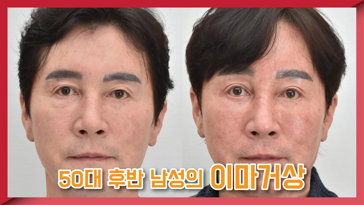 Plastic Surgery in Korea: Endoscopic Brow Lift, Scarless Eye Bag Removal in Mid-50s Male