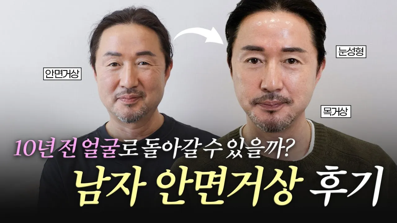 [50대 남자 안면거상술] 얼굴 처짐, 목주름, 처진 눈꺼풀 고민! 수술 전후, 붓기, 회복과정은?