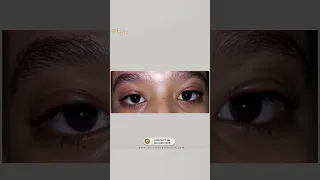 اصلاح ارتخاء الجفون الخلقي مع د انجي الشريف 